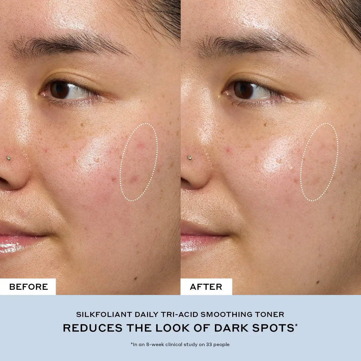 Silkfolaint Gentle Tri-Acid Exfoliating Toner for Dark Spots